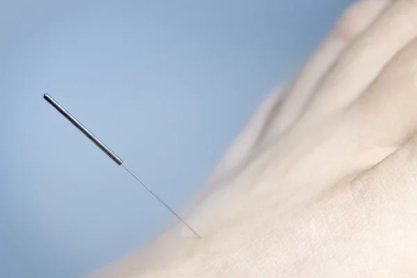 Agulha de acupuntura a pé — Fotografia de Stock