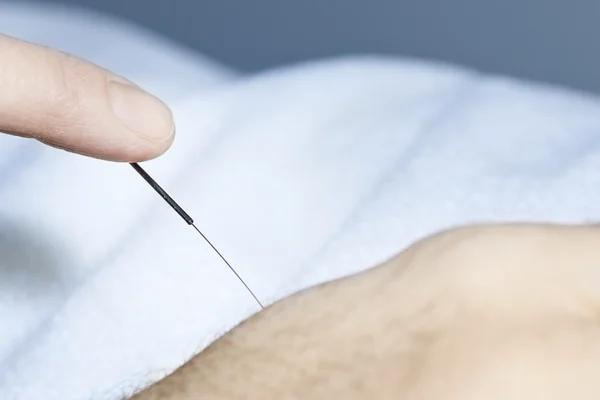 Aiguille d'acupuncture dans la peau — Photo