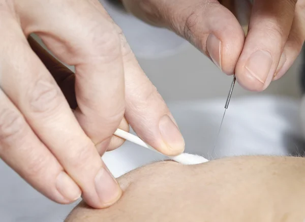 Akupunktur iğnesi Skin — Stok fotoğraf