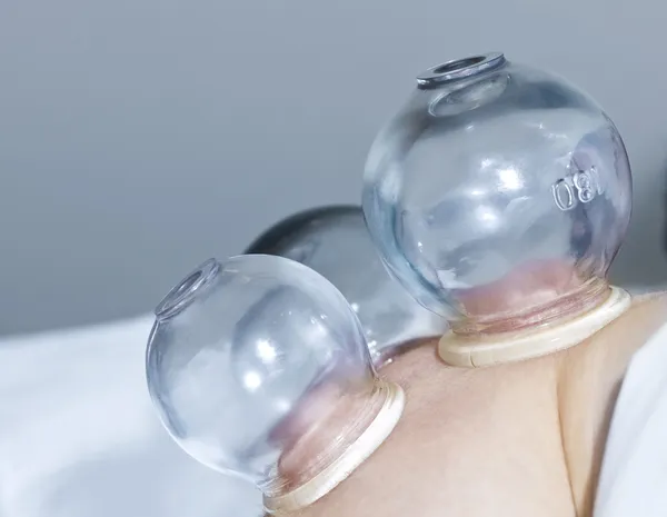Cupping therapy in traditional chinese medicine — Stock Photo, Image