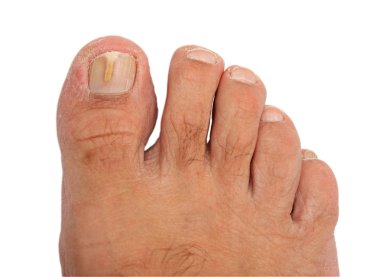 A toenail infected with a fungus clipart