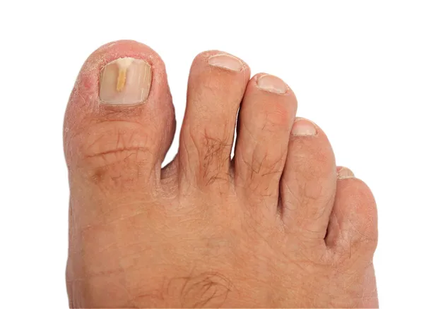 A toenail infected with a fungus — Stock Fotó