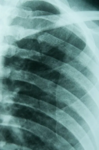 stock image Xray of broken ribs