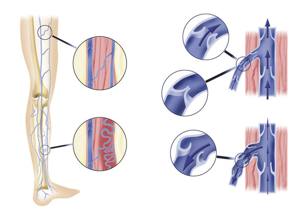 Leg artery and aortic valves
