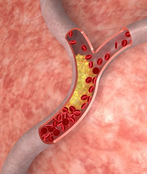 Cholesterol in artery — Stock Photo, Image
