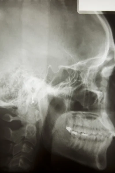 stock image Skull X-Ray