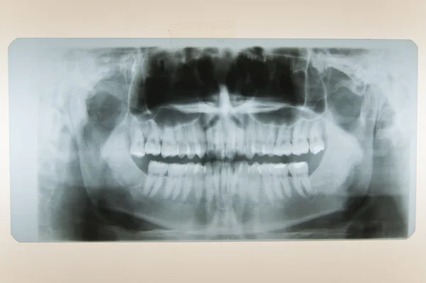 Skull X-Ray — Stock Photo, Image