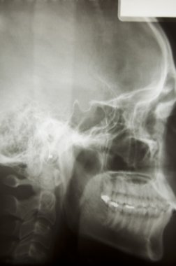 kafatası röntgeni