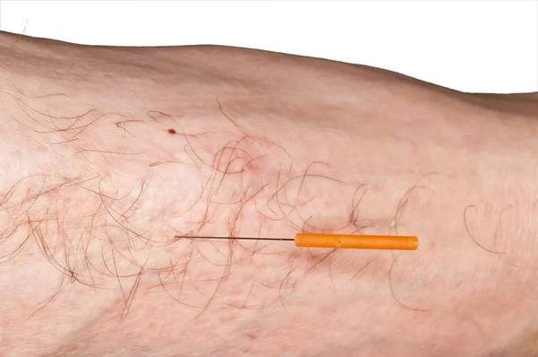 Akupunktur Therapie — 스톡 사진