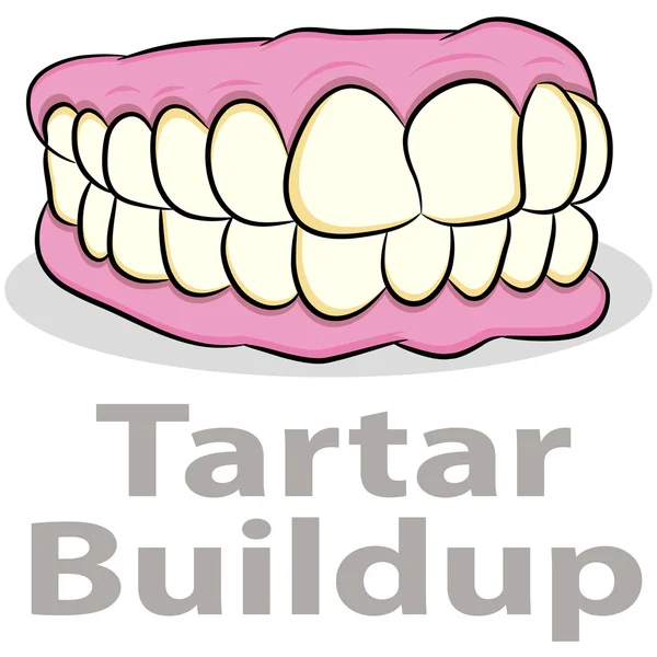 Opbouw van tandsteen op de tanden — Stockvector
