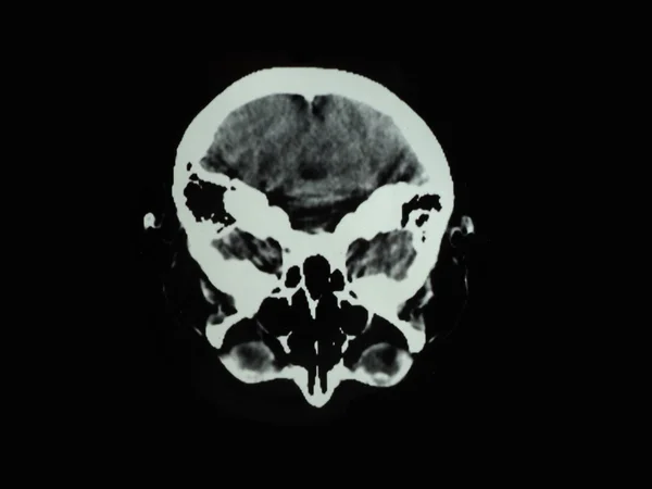 Een momentopname van de menselijke schedel — Stockfoto