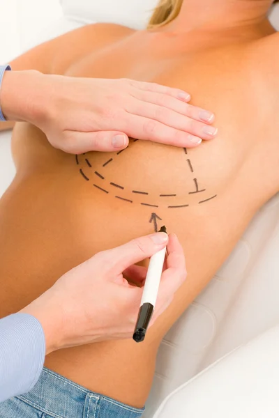 整形外科医生绘制线病人乳房 — 图库照片