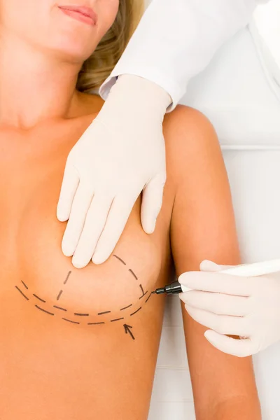 Plastikkirurgi läkare Rita linje patientens bröst — Stockfoto