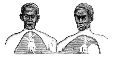 Siamese twins. V. Vena cava. f. Upper limit of the common axis, clipart