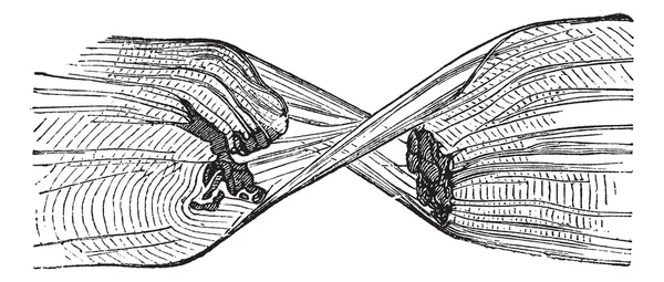 Разорванное мышечное волокно, старинная гравированная иллюстрация — стоковый вектор
