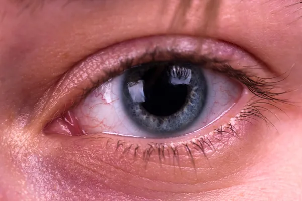 Усталые глаза и контактные линзы — стоковое фото