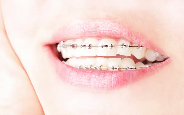 Zähne mit Zahnspange — Stockfoto