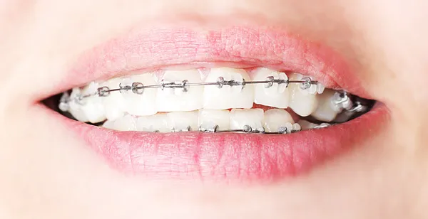 Diş diş teli ile — Stok fotoğraf