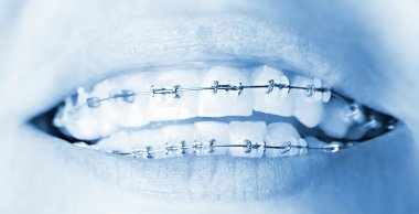 Teeth with braces clipart