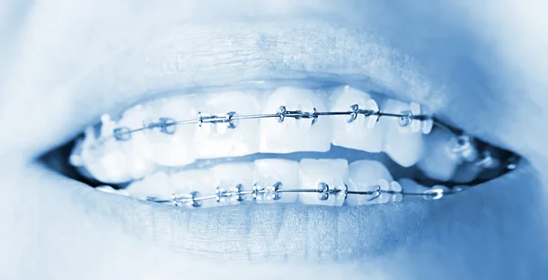 Dentes com aparelho — Fotografia de Stock
