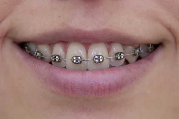 stock image Smiling girl with brackets on her teeth