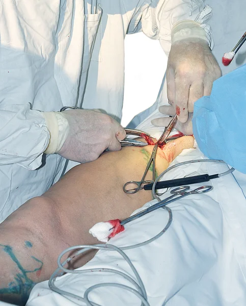 Operacja w szpitalu — Zdjęcie stockowe