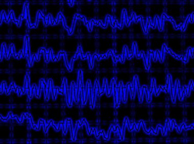 beyin dalga encephalogram eeg