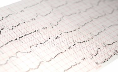 Elektrokardiyogram EKG, ekg