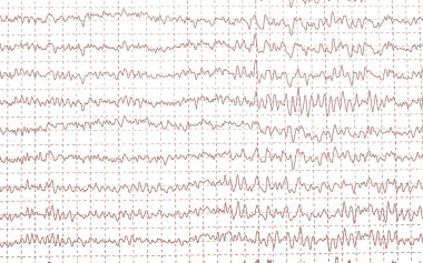 Beyin dalgaları electroencephalogramme (Eeg)