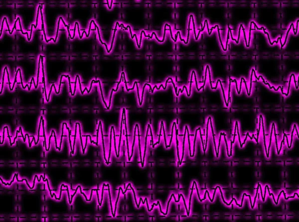 Brain wave on encephalogram EEG — Stock Photo, Image