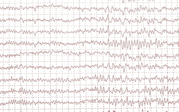 Eletroencefalograma de ondas cerebrais (EEG) ) — Fotografia de Stock