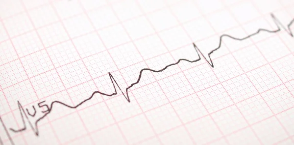 EKG graf, elektrokardiogram ekg — Stock fotografie