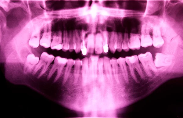 stock image Dental X-ray