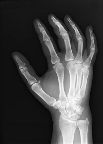 Röntgenhand X-ray — стокове фото