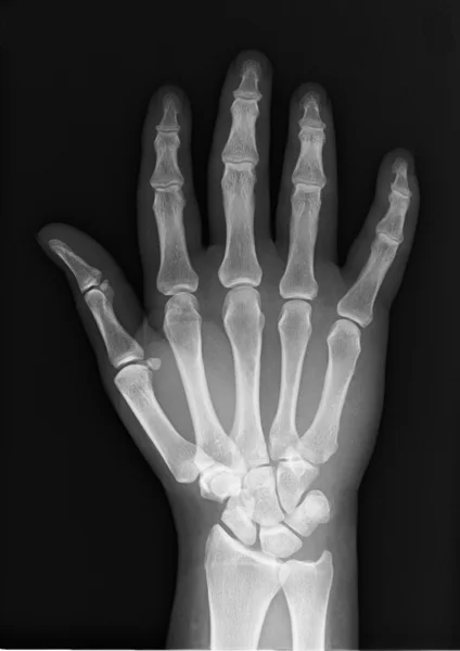 Röntgenhand X-ray — Zdjęcie stockowe