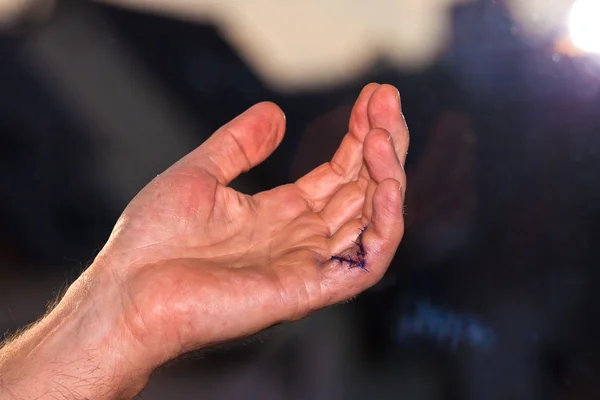 Serçe parmağı bir ameliyattan sonra dikişli — Stok fotoğraf