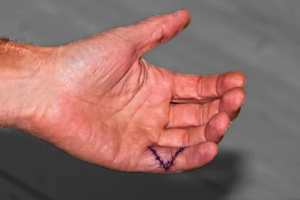 Dedo meñique cosido después de una operación —  Fotos de Stock
