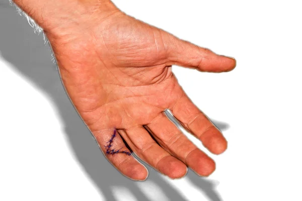 Μικρό δάκτυλο ραμμένες μετά από επέμβαση操作の後の小さな指のステッチ — ストック写真
