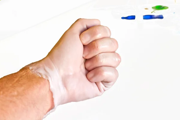 Hand-Physiotherapie zur Bergung eines gebrochenen Finders — Stockfoto