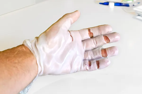 Φυσικοθεραπεία χεριών για την ανάκτηση ενός σπασμένου ανιχνευτή — Φωτογραφία Αρχείου