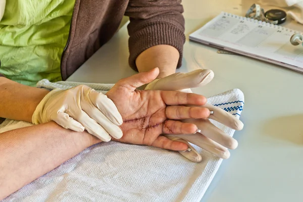 Hand physiotherapy to recover a finger — Stock Photo, Image