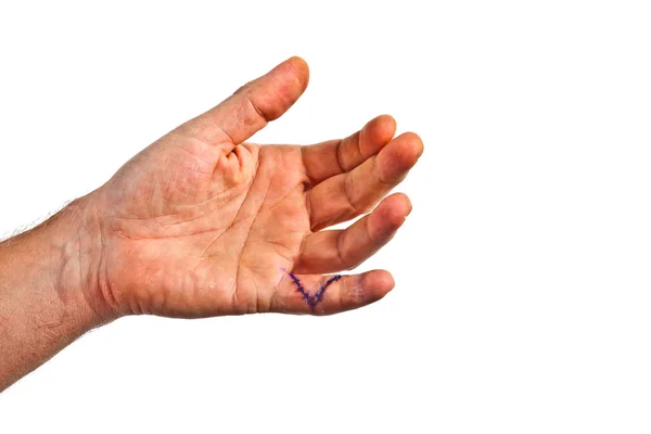 Mão com uma ferida de operação no dedo pequeno — Fotografia de Stock