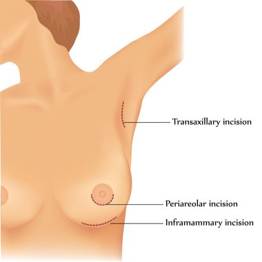 Plastic surgery of breast implants clipart