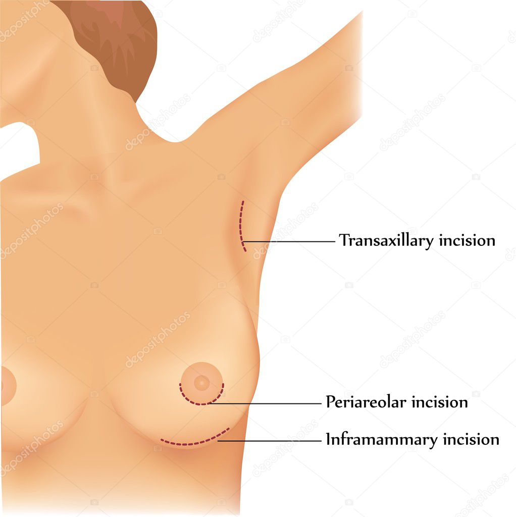 Plastic surgery of breast implants
