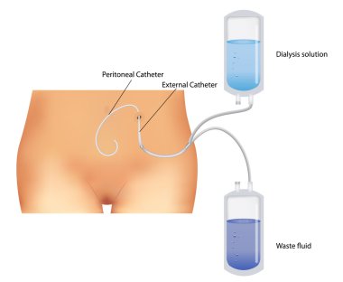 Peritoneal dialysis. Renal insufficiency. clipart