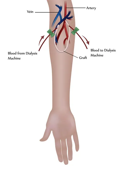 血液透析过程 — 图库矢量图片