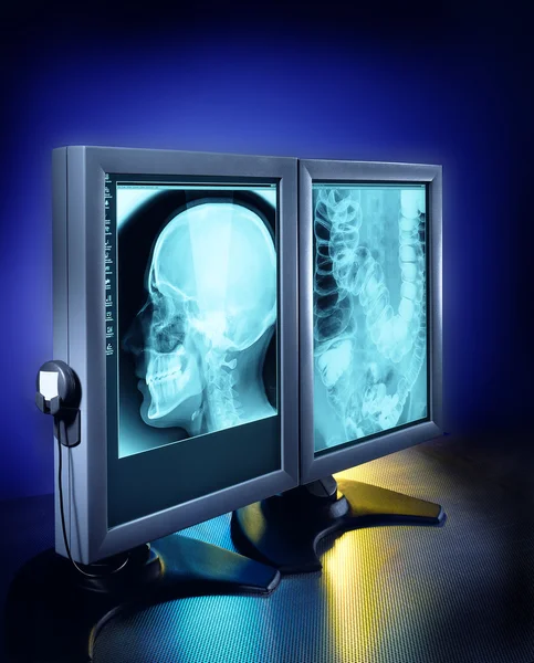 Röntgenbilder auf dem Computerbildschirm — Stockfoto