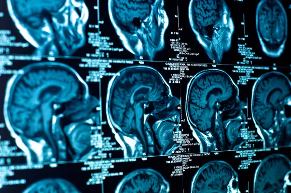 Closeup of a CT scan with brain — Stock Photo, Image