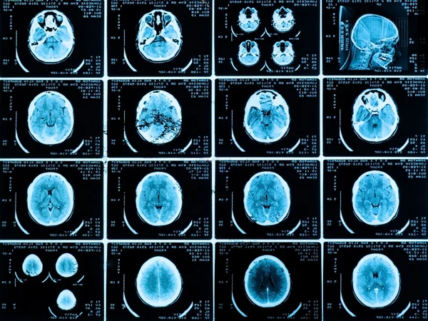 Scans of the brain — Stock Photo, Image