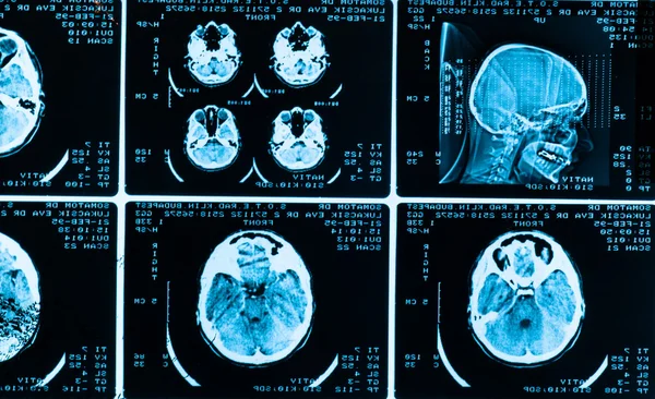 Багато типів сканування мозку з темним фоном — стокове фото